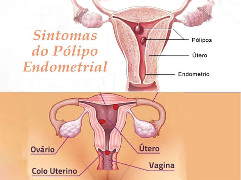 Polipo Endometrial
