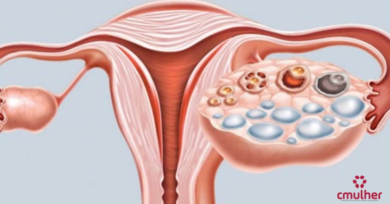 As sete doenças mais comuns: Ovários Policísticos