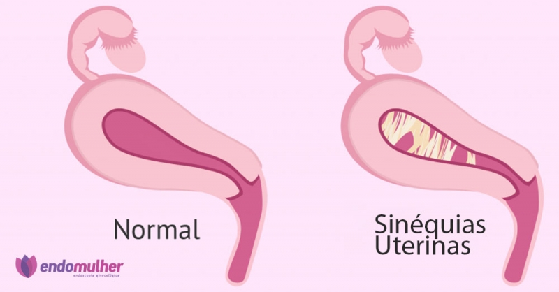 Sinéquias Uterina ou Aderências Uterinas