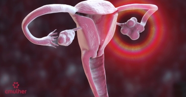 O que é Síndrome de Hiperestimulação Ovariana?