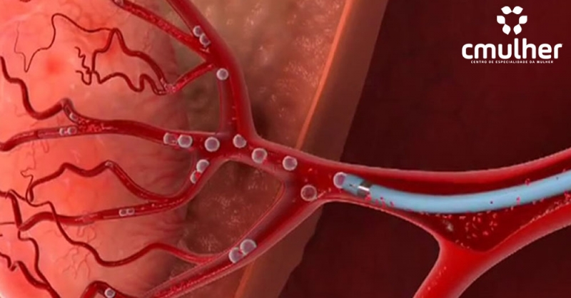 O que é embolização de Mioma Uterino?