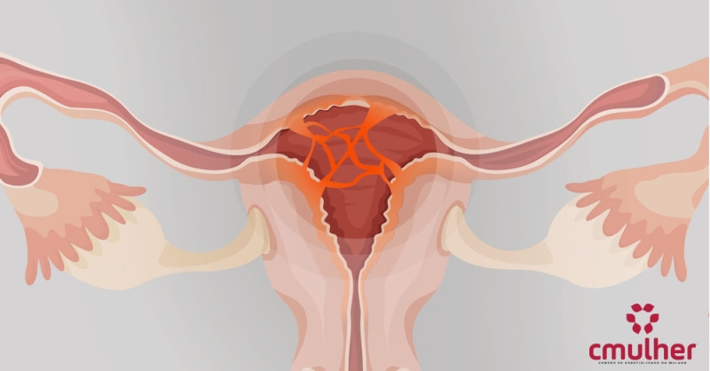 Sinéquias Uterina - Causas e Diagnósticos